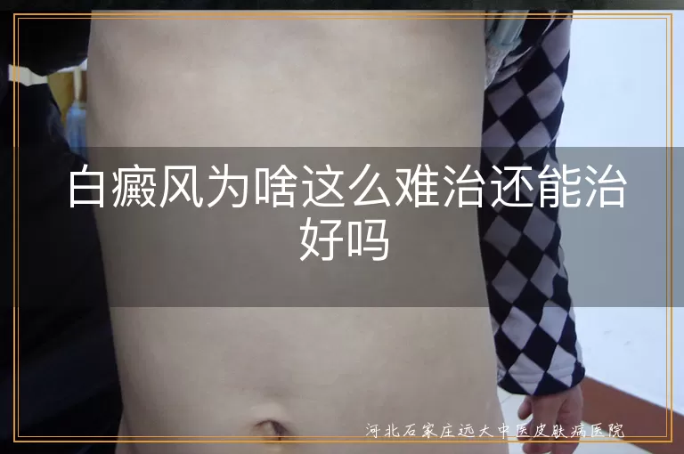 白癜风为啥这么难治还能治好吗,白斑久治不愈到底是怎么回事啊,白癜风治疗难度大原因是什么