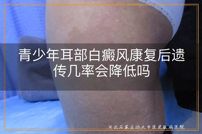 青少年耳部白癜风康复后遗传几率会降低吗