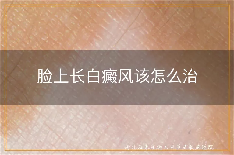 脸上长白癜风该怎么治