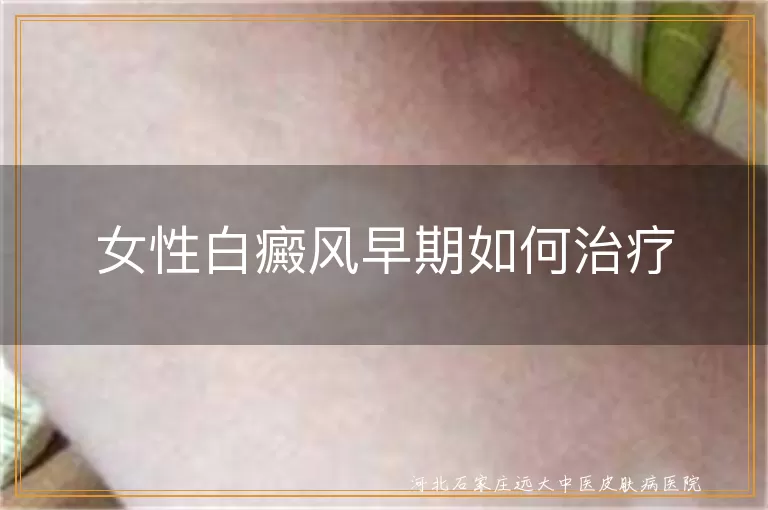 女性白癜风早期如何治疗