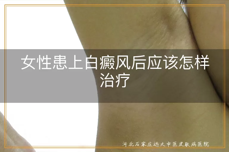 女性患上白癜风后应该怎样治疗