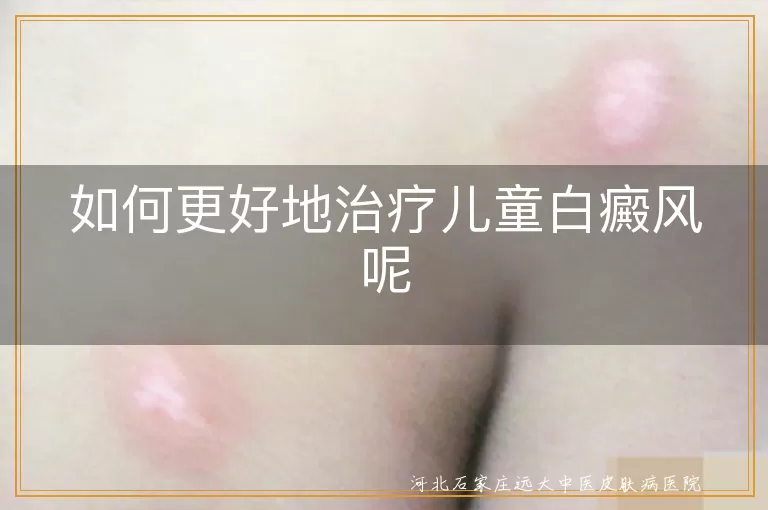 儿童白癜风怎么治疗效果比较好,儿童白斑病怎样才能治好呢,孩子得了白癜风如何治疗效果佳