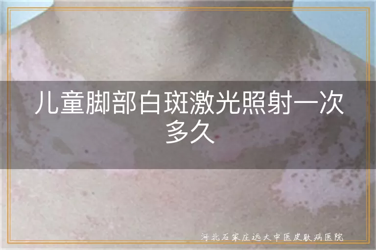 儿童脚部白斑激光多久,儿童白癜风激光治疗时间,脚部白斑照激光时长多久