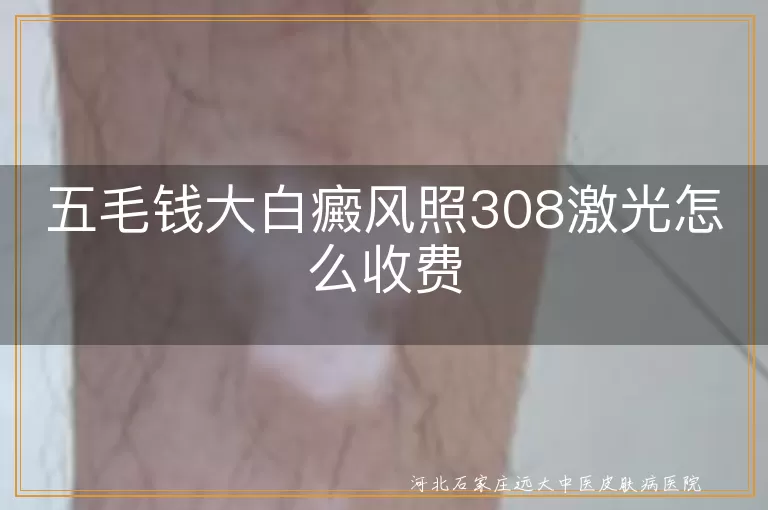 硬币大小白癜风照激光收费情况,小块白癜风308激光治疗价格,白斑照308激光费用怎么算
