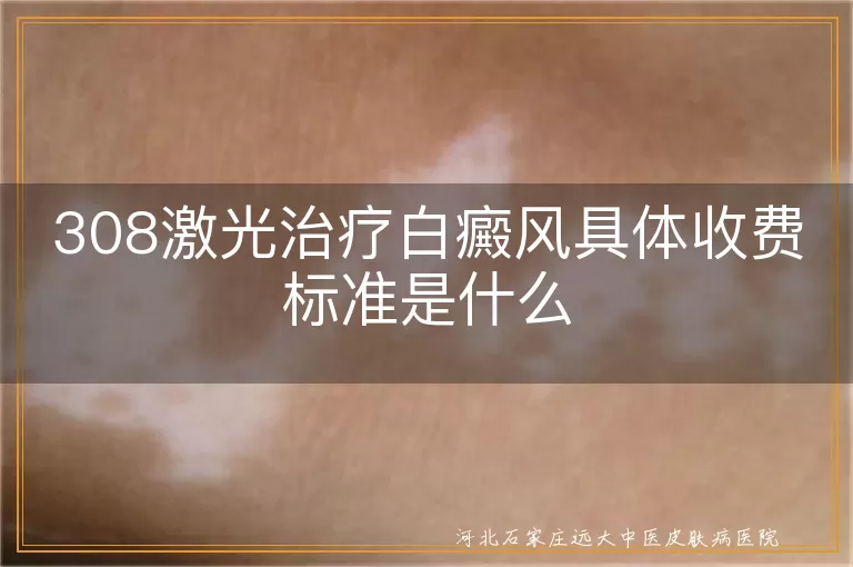 308激光治疗白癜风具体收费标准是什么