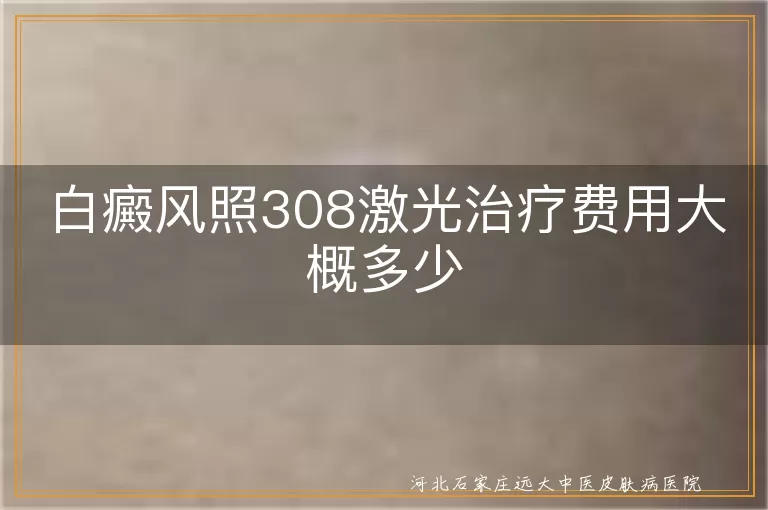 白癜风照308激光治疗费用大概多少