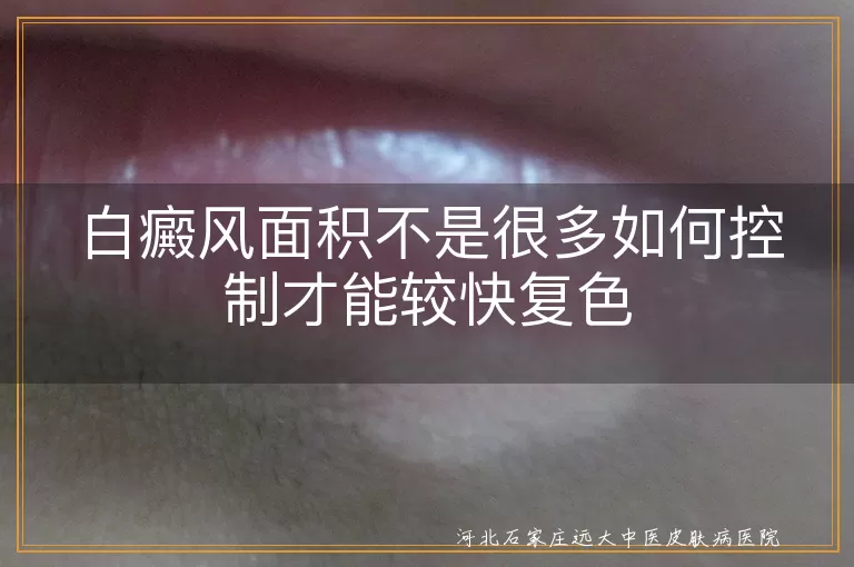 白癜风面积不是很多如何控制才能较快复色