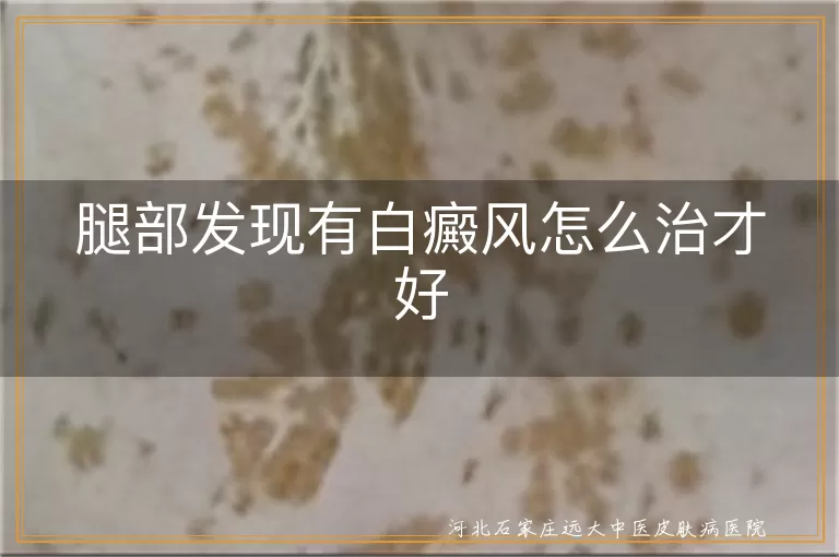 腿部发现有白癜风怎么治才好,腿上的白斑如何治疗能恢复,腿部白癜风治疗方法哪些有效