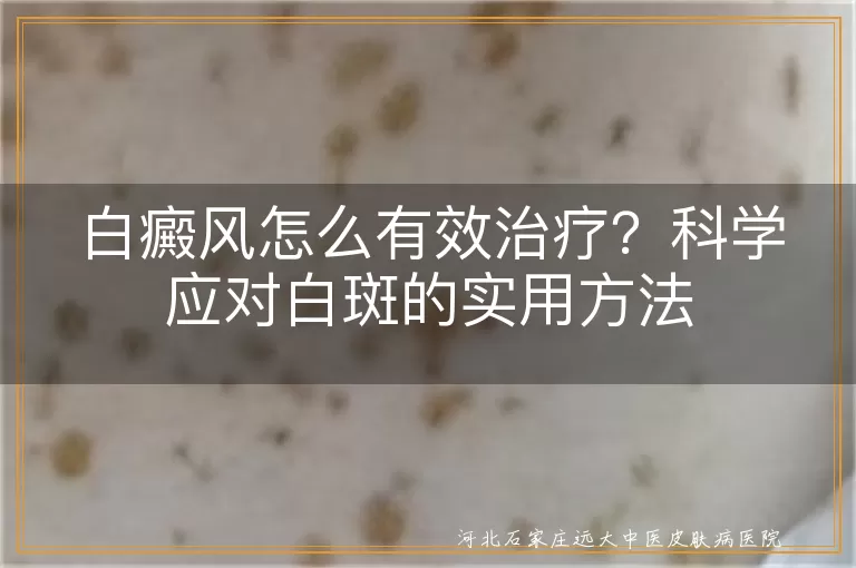 白癜风有效治疗方法,白斑怎么治疗效果好,治疗白癜风最有效的方式