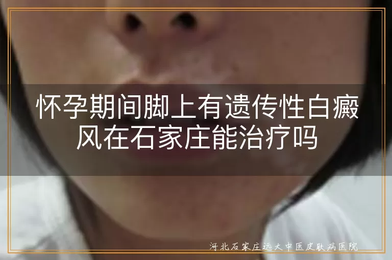 孕期脚上遗传白斑能治疗吗,石家庄怀孕脚部白癜风咋办,怀宝宝脚上白癜风遗传能控制吗