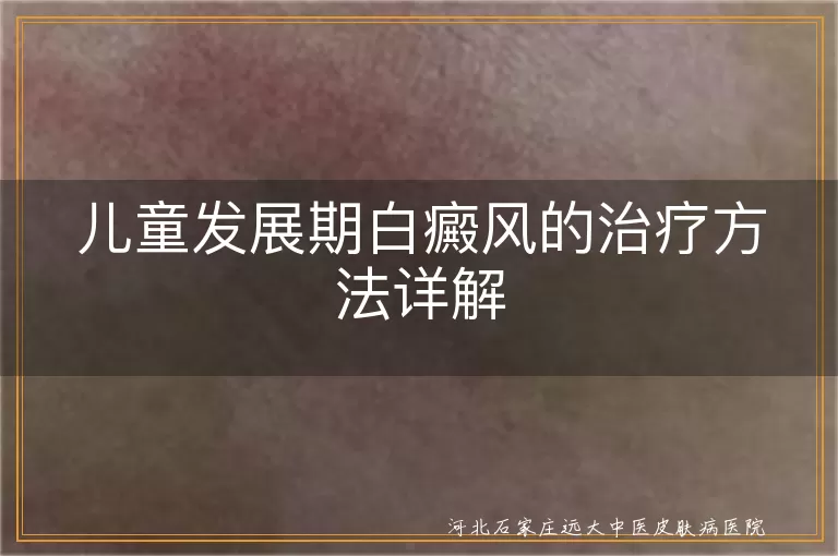 儿童发展期白癜风治疗的好方法,孩子白斑发展期该怎么治疗呢,儿童白斑发展期治疗方法有哪些