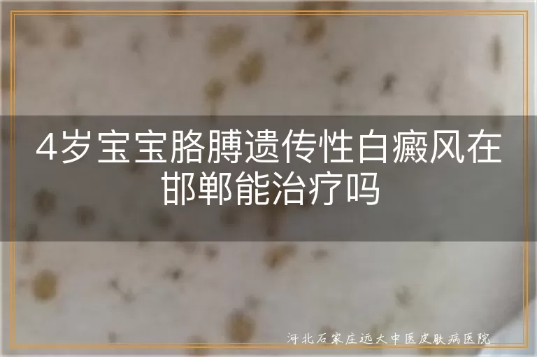 儿童胳膊遗传白癜风邯郸能治吗,宝宝胳膊出现白斑在邯郸如何治疗,4岁孩子遗传性白斑在邯郸能恢复吗