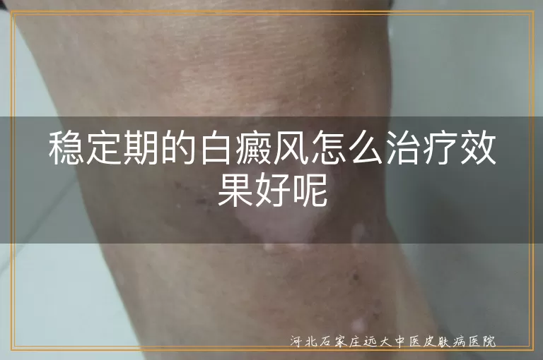 稳定期白癜风治疗方法有哪些,白斑不扩散了怎么治疗好,白癜风稳定期如何有效治好