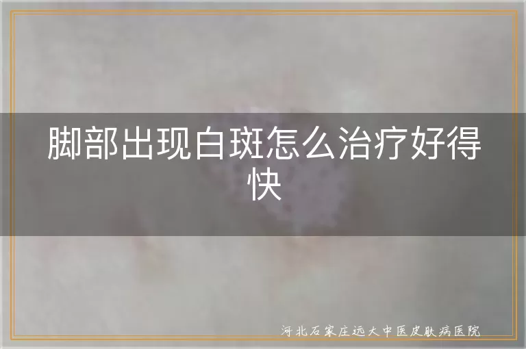 脚部出现白斑怎么治疗好得快