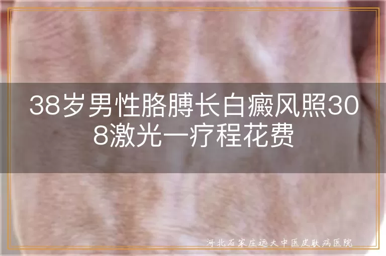 38岁胳膊白斑照308激光一疗程价格,男性手臂白癜风308光疗疗程费用,成年人胳膊长白斑308激光一个疗程花销