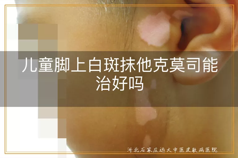 孩子脚部白癜风擦他克莫司有效吗,小孩脚上有白点涂他克莫司能好吗,儿童脚部白斑用他克莫司能恢复吗