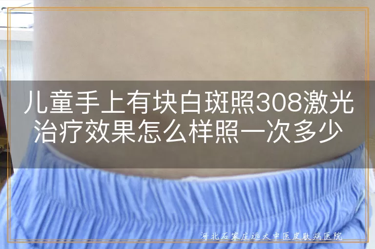 儿童手上有块白斑照308激光治疗效果怎么样照一次多少