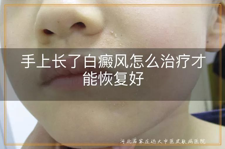 手部白癜风怎么治疗有效果,手上白斑的治疗方法有哪些,手部患白癜风该怎么治才好
