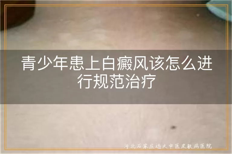 青少年患上白癜风该怎么进行规范治疗