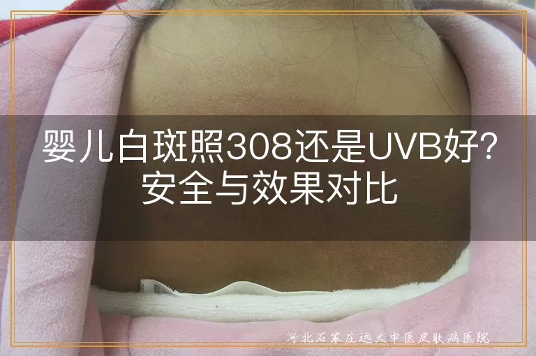 婴儿白斑照308还是UVB好?安全与效果对比