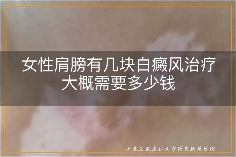 女性肩膀有几块白癜风治疗大概需要多少钱