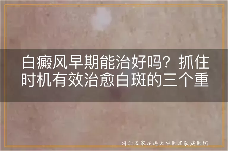 白癜风早期能治好吗？抓住时机有效治愈白斑的三个重点
