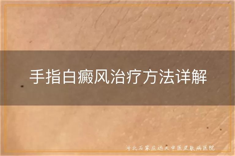 手指白癜风怎样治疗,手指长白癜风怎么办,白斑在手指如何治疗
