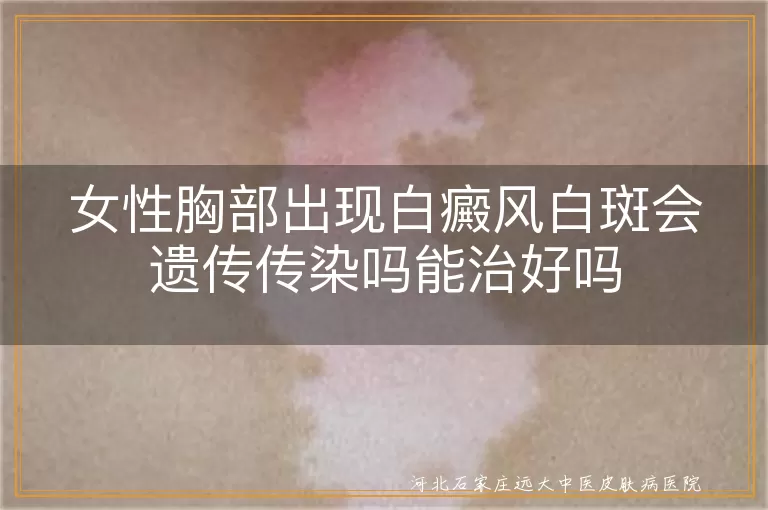 女性胸部白斑会遗传给后代吗,胸部白癜风会不会传染别人,女性胸部白癜风白斑能治好吗