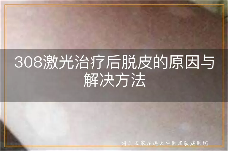 白癜风308激光脱皮原因怎么应对,白斑308照射后脱皮解决方法,308激光治白癜风脱皮了怎么处理