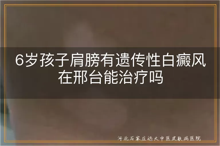 6岁宝宝肩膀遗传白斑能治疗吗邢台, 邢台治孩子肩部遗传白癜风办法, 儿童肩膀遗传性白斑在邢台如何恢复