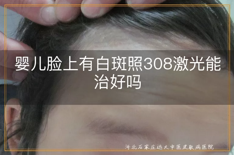 婴儿脸上有白斑照308激光能治好吗