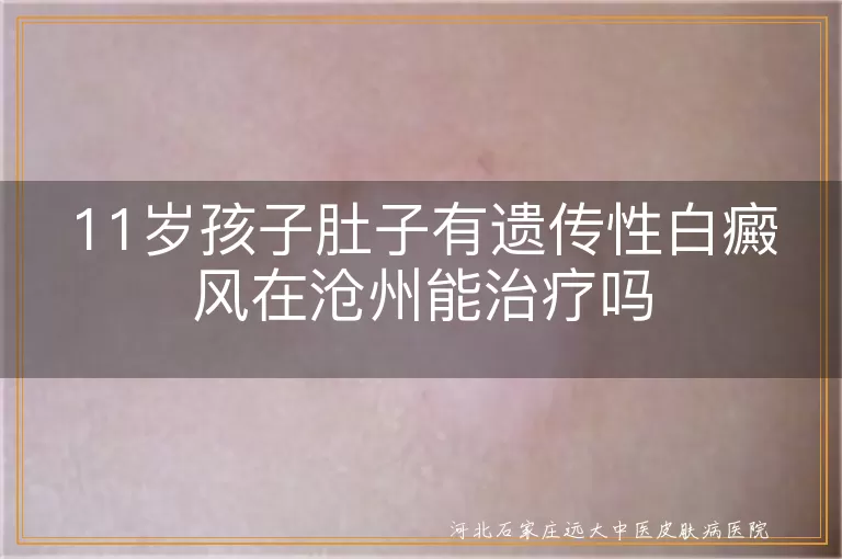 沧州儿童遗传性白斑治疗可行吗,11岁男孩腹部白癜风沧州咨询,孩子肚子白斑沧州能治好吗