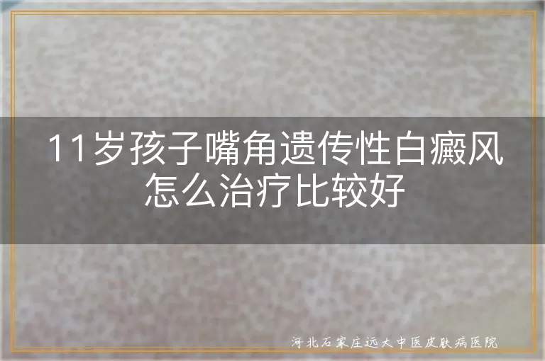 孩子嘴角白斑遗传白癜风治疗,11岁嘴角白癜风如何治疗好,儿童遗传嘴角白斑治疗办法