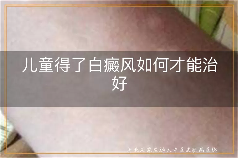 儿童白癜风怎么治疗才能好彻底,孩子身上白斑如何才能治好,儿童白斑用什么方法治疗好