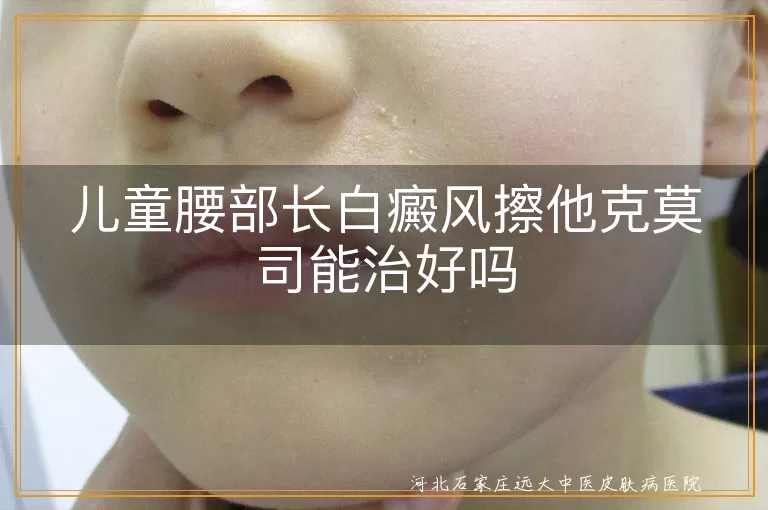 儿童腰部白斑用他克莫司行吗,孩子腰上长白癜风能擦他克莫司吗,腰部长白癜风小孩抹他克莫司好不好