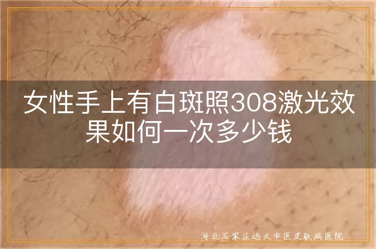 女性手上白斑照308激光效果,手上白癜风308激光一次多少钱,手部长白斑用308激光能好吗
