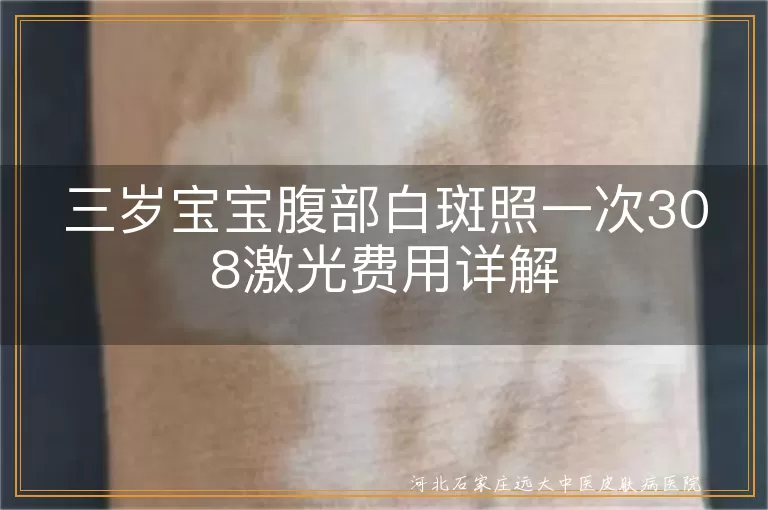 宝宝腹部长白斑是白癜风吗,儿童白癜风308激光价格,三岁白斑照光一次多少钱