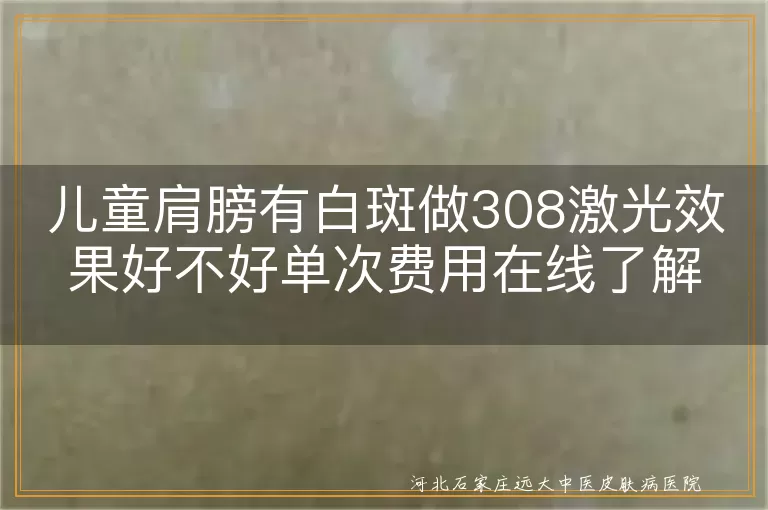 儿童肩膀白斑照308效果好吗,白癜风单次激光治疗费用在线问,孩子肩膀白斑做一次308贵不贵