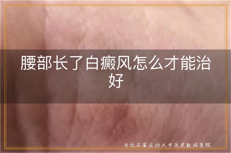 腰部长了白癜风怎么才能治好
