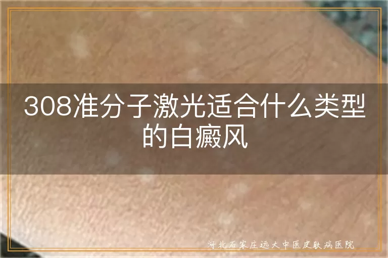 308准分子激光适合哪种类型的白癜风,308激光治疗白斑哪种类型效果好,不同类型的白癜风白斑适合308吗