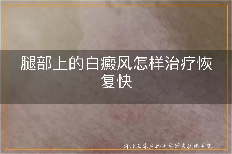 腿部白斑怎么治疗恢复得快,腿部白癜风怎么治疗才能恢复得快,腿部有白癜风如何加快康复速度