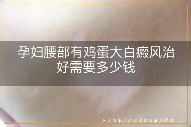 孕妇腰部有鸡蛋大白癜风治好需要多少钱