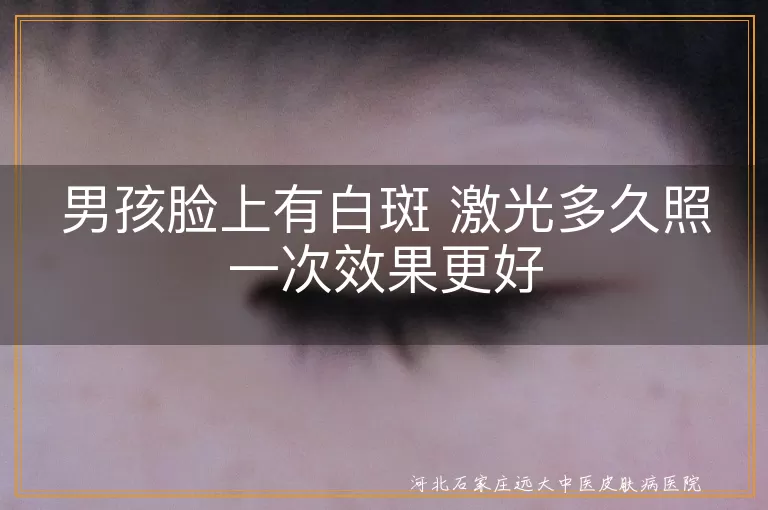 男孩脸上白斑多久照激光合适,儿童面部白癜风激光治疗间隔,男孩白斑照激光多久一次见效