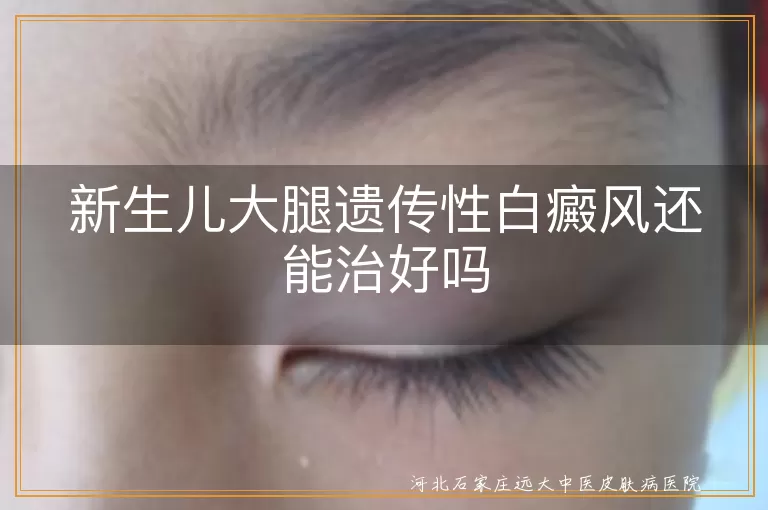 遗传性新生儿大腿白癜风能治好吗,婴儿大腿上白斑遗传性怎么治疗,宝宝腿部遗传性白癜风能恢复么