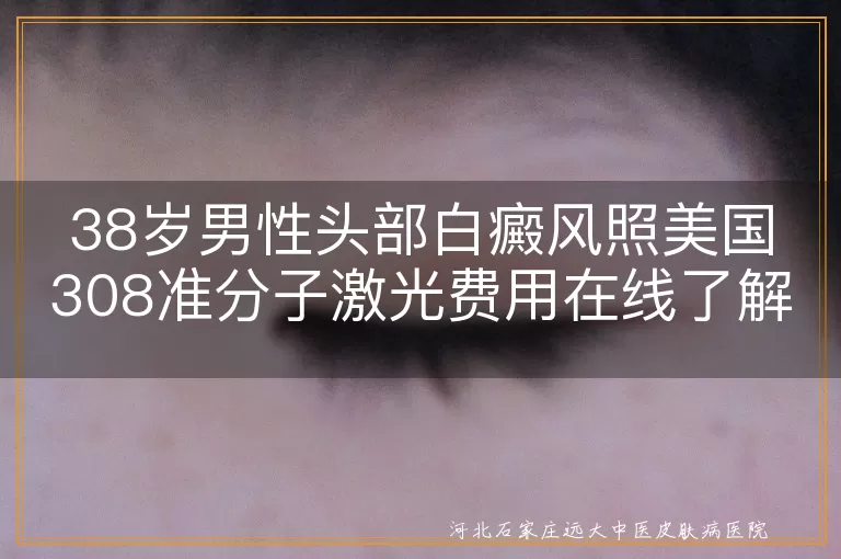 38岁男性头部白癜风照美国308准分子激光费用在线了解