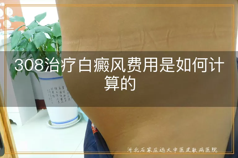 308治疗白癜风费用是如何计算的