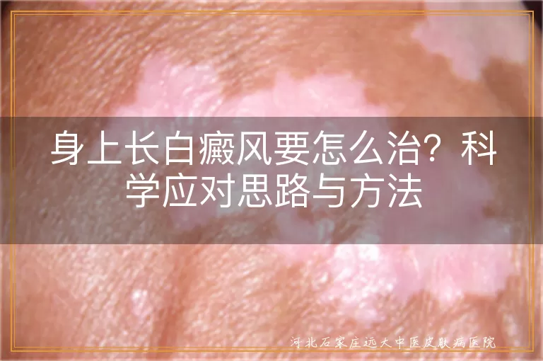 身上长白癜风要怎么治？科学应对思路与方法