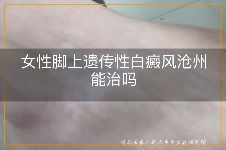 女性脚部遗传白斑沧州治疗可行吗,沧州女性遗传性白癜风如何治疗,脚上白斑遗传可以治吗沧州