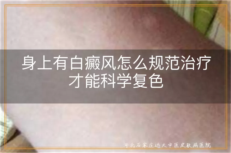 身上白癜风如何规范治疗,白斑怎样治疗才算规范,身上长白癜风科学治疗流程