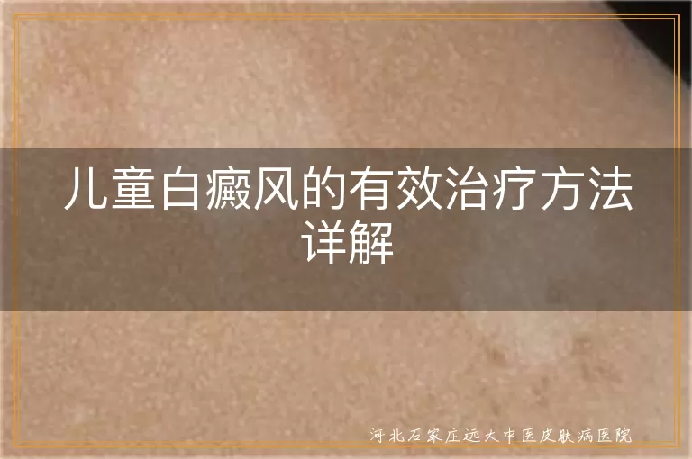 儿童白斑治疗有效方法,小孩白癜风怎么治才好,儿童皮肤白斑治疗手段